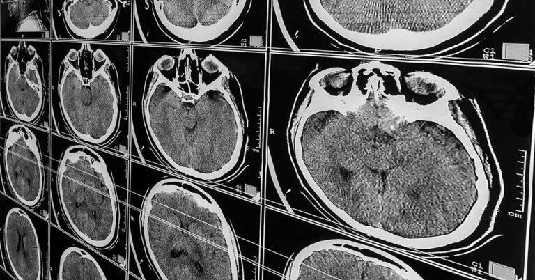 Making a Brain Injury Claim: What to Expect