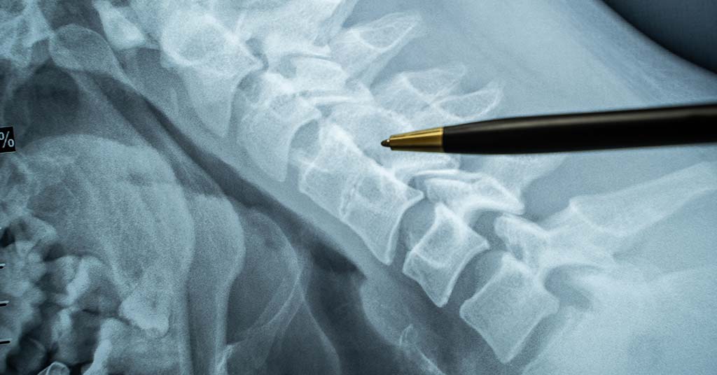 spinal anaesthesia